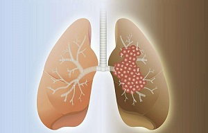 肺癌.jpg