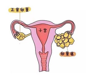 郑州治疗卵巢癌的中医院