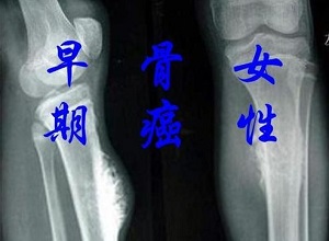 郑州治疗骨癌的中医馆